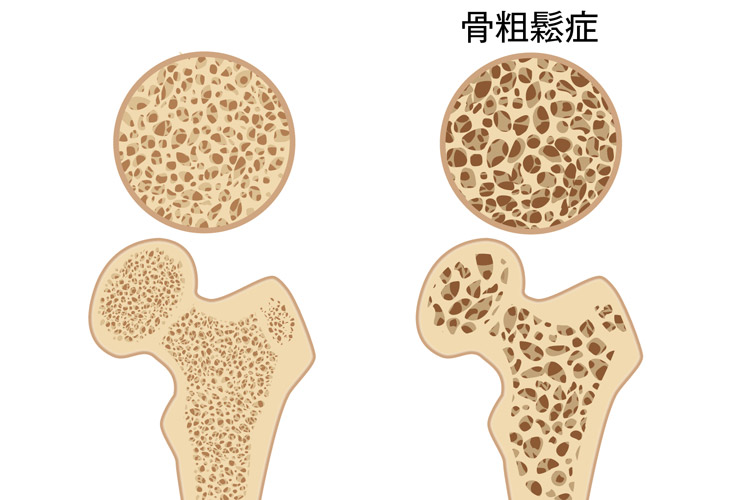 骨粗鬆症
